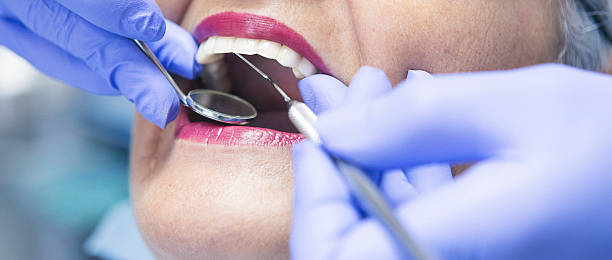 Best Knocked-Out Tooth (Avulsed Tooth) Treatment in Santa Barbara, CA